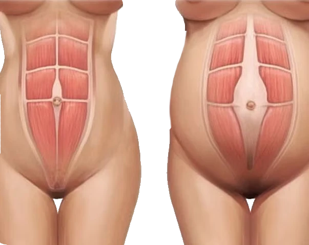 Diástase abdominal